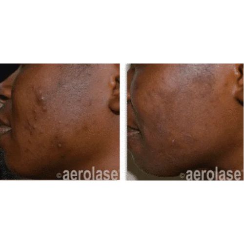 Acne Treatment using Aerolase Before After | Skin and Tonic | Pace, Florida, US