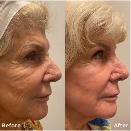CO2 Resurfacing Laser Before After | Skin and Tonic | Pace, Florida, US