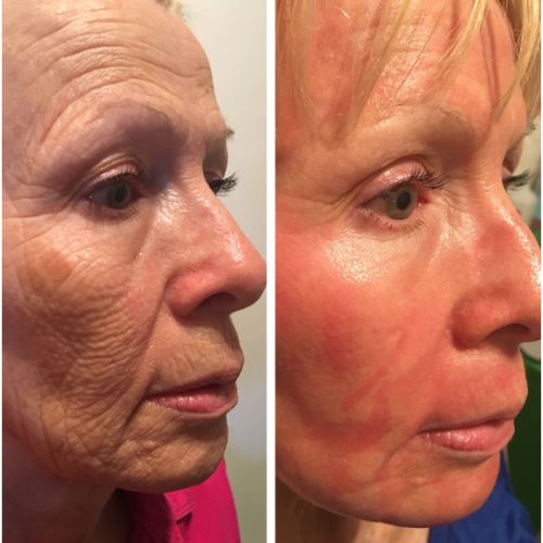 CO2 Resurfacing Laser Before After | Skin and Tonic | Pace, Florida, US