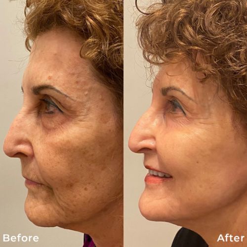 CO2 Resurfacing Laser Before After | Skin and Tonic | Pace, Florida, US