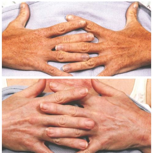 CO2 Resurfacing Laser Before After | Skin and Tonic | Pace, Florida, US