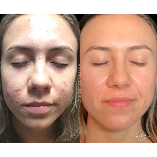 Combintion Therapy ZO Skin Health regimen, Aerolase Neo, Reverse Laser Treatment Before-After__skinandtonic | Skin and Tonic | Pace, Florida, US