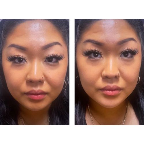 Dermal Filler Before-After skinandtonic | Skin and Tonic | Pace, Florida, US