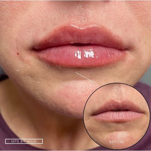 Lip Filler Treatment Before-After_skinandtonic | Skin and Tonic | Pace, Florida, US