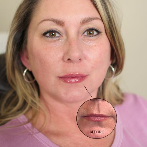 Lip Filler Treatment Before-After_skinandtonic | Skin and Tonic | Pace, Florida, US