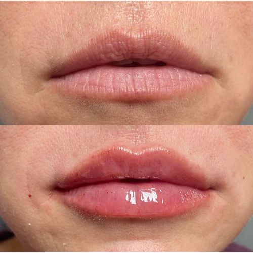 Lip Filler Treatment Before-After_skinandtonic | Skin and Tonic | Pace, Florida, US