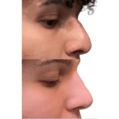 Liquid Rhinoplasty + Threadlift Before After skinandtonic | Skin and Tonic | Pace, Florida, US