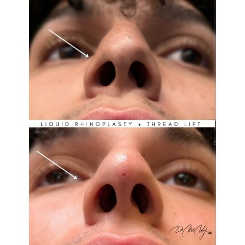 Liquid Rhinoplasty + Threadlift Before After skinandtonic | Skin and Tonic | Pace, Florida, US