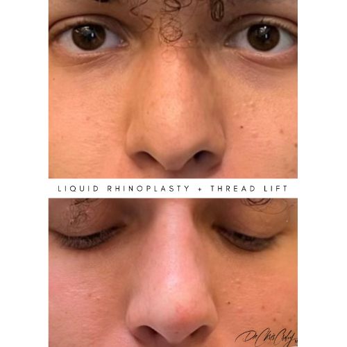 Liquid Rhinoplasty + Threadlift Before After skinandtonic | Skin and Tonic | Pace, Florida, US