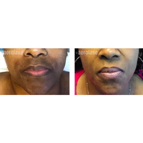Melasma Treatment using Aerolase Before After | Skin and Tonic | Pace, Florida, USskinandtonic | Skin and Tonic | Pace, Florida, US