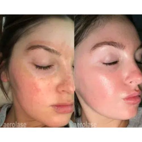 Melasma Treatment using Aerolase Before After skinandtonic | Skin and Tonic | Pace, Florida, US
