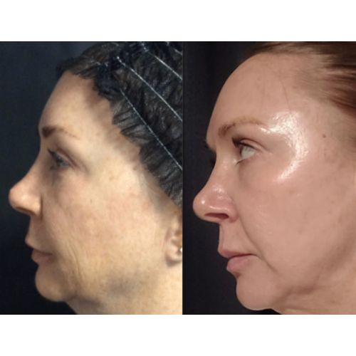 NeoGen Plasma Before After skinandtonic | Skin and Tonic | Pace, Florida, US