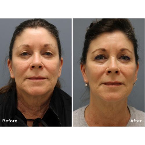 RF Microneedling Before After skinandtonic | Skin and Tonic | Pace, Florida, US