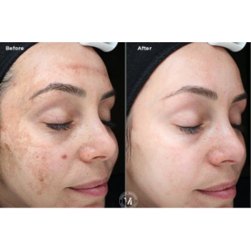 VI Peel (Chemical Peel) Before After skinandtonic | Skin and Tonic | Pace, Florida, US
