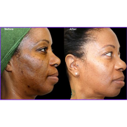 VI Peel (Chemical Peel) Before After skinandtonic | Skin and Tonic | Pace, Florida, US