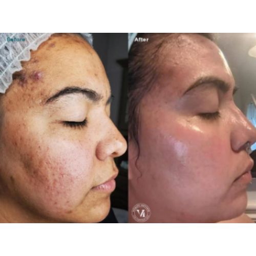 VI Peel (Chemical Peel) Before After skinandtonic | Skin and Tonic | Pace, Florida, US