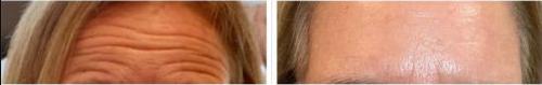 Before and After Images Dysport Treatment at Skin and Tonic | Pace, Florida, US
