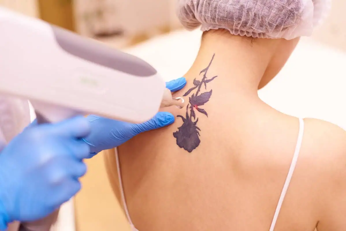 Tattoo Removal Treatment By Skin & Tonic Medical Spa in Pace, FL